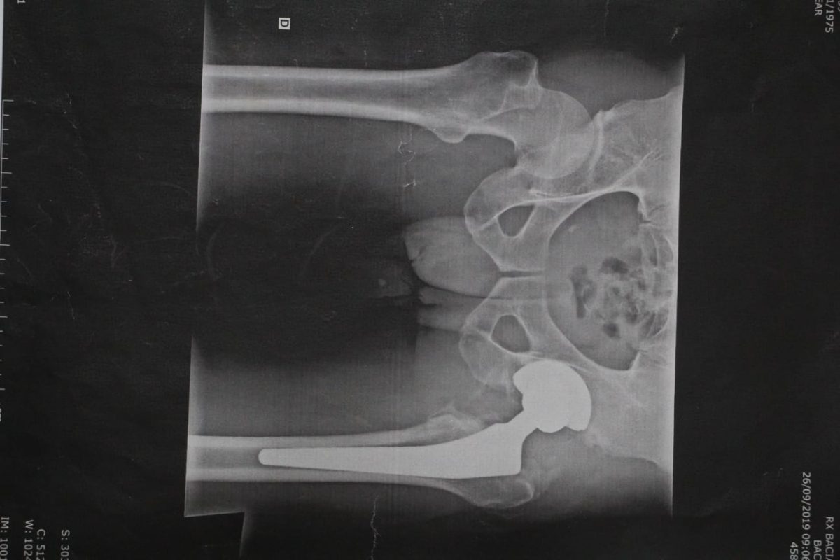 O raio-x dele indicava uma infecção na perna que tinha a prótese antiga