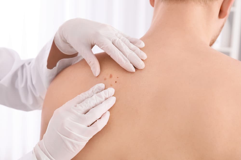 Dermatologista examinando câncer de pele