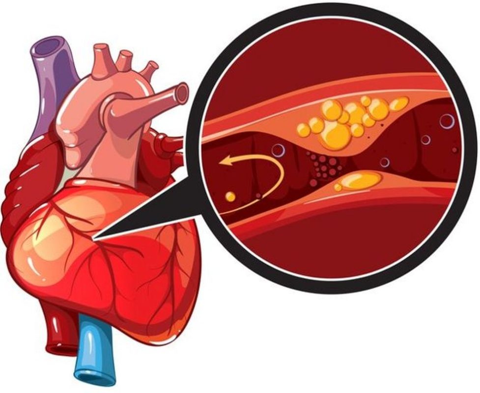 O entupimento das coronárias (as artérias do coração), como ilustrado na imagem, pode ter a ver com um estresse agudo — Foto: GETTY IMAGES/BBC
