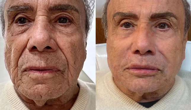 stênio garcia faz harmonização facial