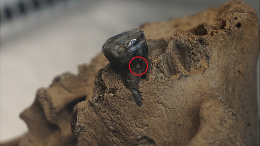 Dente do crânio de Harbin, do qual foi extraída a amostra de cálculo dentário que possibilitou a captura e sequenciamento do mtDNA