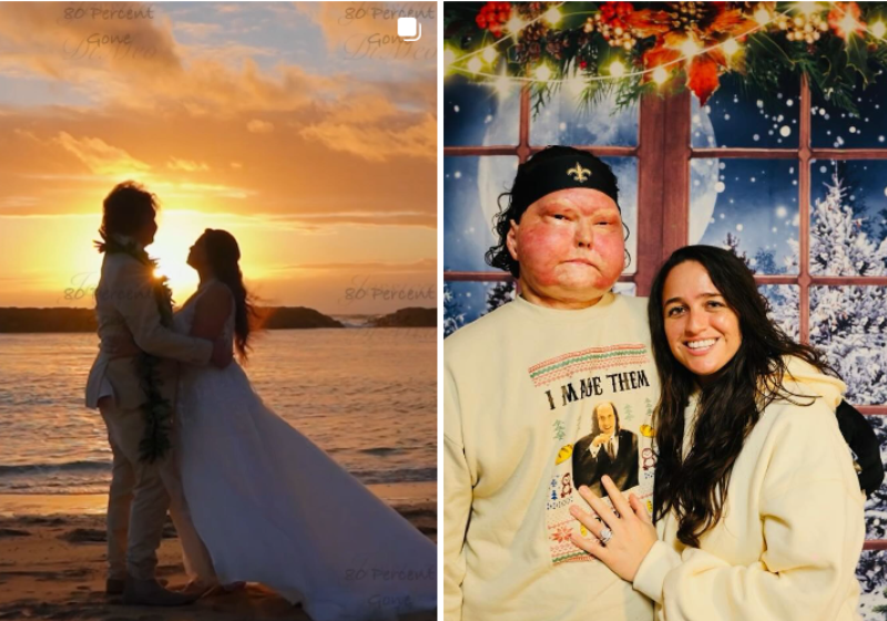 Homem que fez transplante de rosto se casa com enfermeira que cuidou dele; “confiança” Joe DiMeo, o primeiro homem a fazer transplante de rosto e mão, se casou com a enfermeira Jessica, que cuidou dele. - Foto: @joedimeo