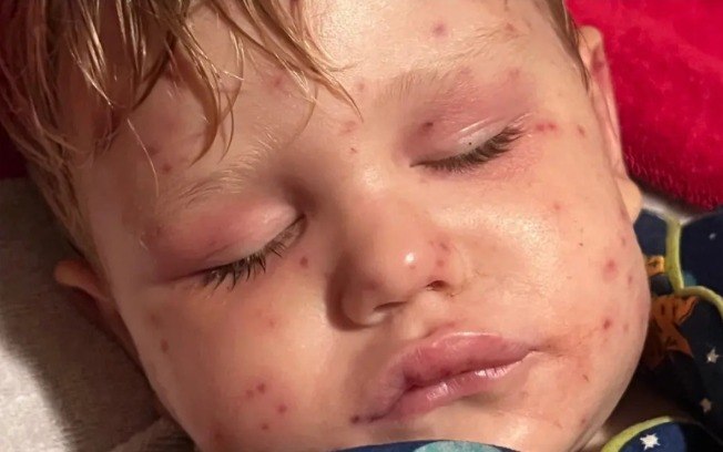 Menino de 2 anos quase morre após 150 picadas de vespas Menino de 2 anos quase morre após 150 picadas de vespas