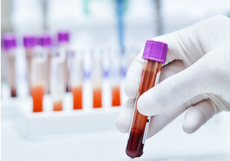 Exame de sangue revolucionário para pacientes com câncer de mama e pulmão evita quimioterapia O novo exame de sangue deve ajudar pacientes com câncer a conseguir tratamentos e diagnósticos mais rápidos para iniciar as terapias. - Foto: kukhunthod/iStock