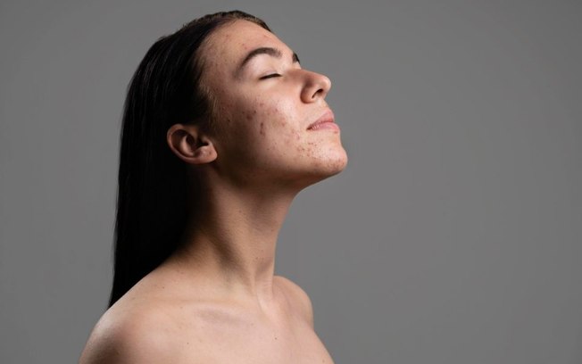 Desbalanço hormonal: como o ciclo menstrual se associa a doenças de pele