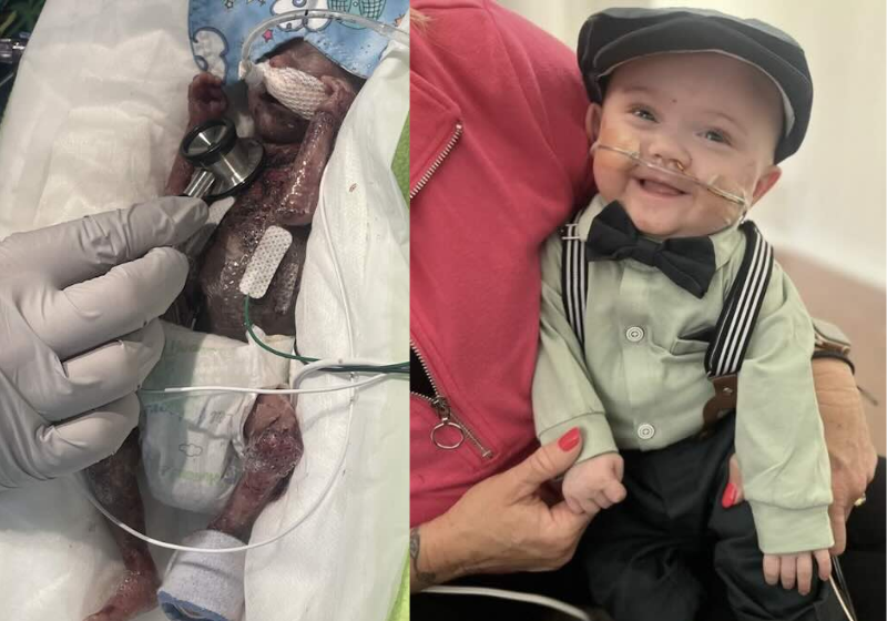 Bebê mais prematuro do mundo vingou, cresceu e está lindo! Nash foi considerado o bebê mais prematuro do mundo e até entrou para o Guiness - Foto: arquivo pessoal