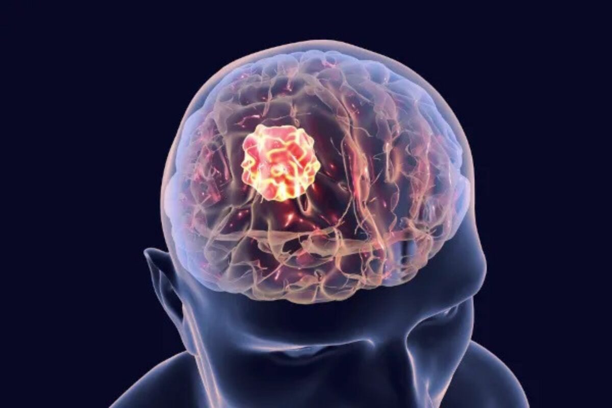 A Anvisa aprovou o registro do medicamento que impede o crescimento de tumor cerebral. - Foto: neuromadoacustico