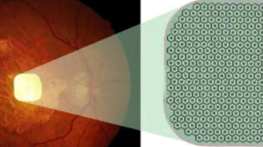 Fotografia do implante PRIMA implantado na retina humana (esquerda) e ampliado para mostrar detalhes (direita)