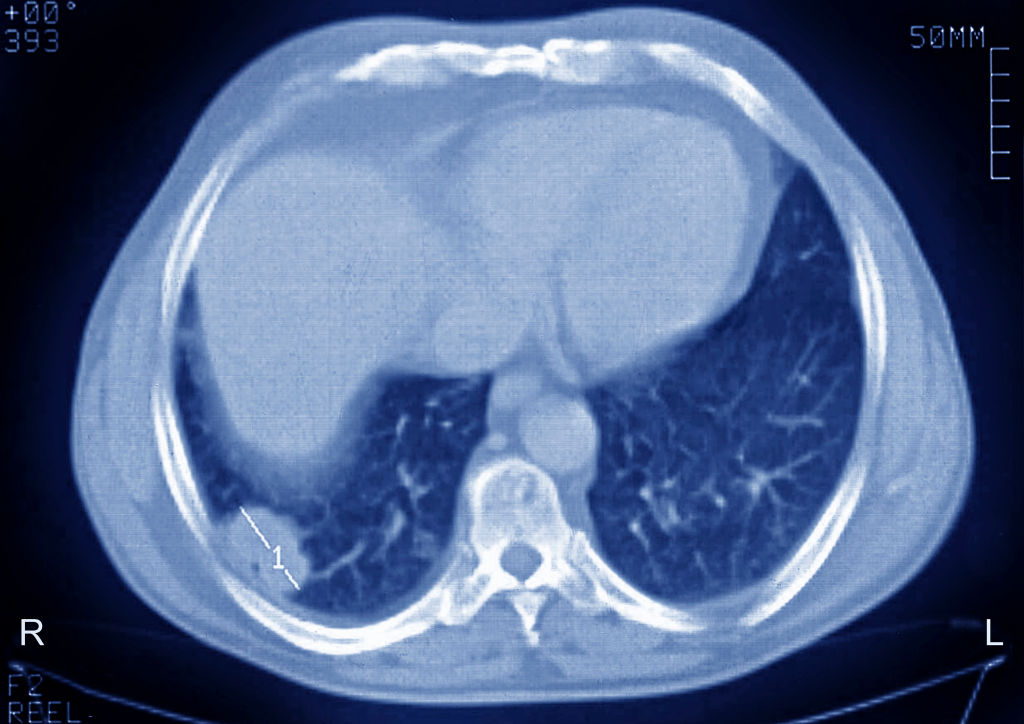 Metástases pulmonares de câncer secundário, carcinoma. Tomografia computadorizada torácica em corte axial. (Foto de BSIP/UIG via Getty Images)